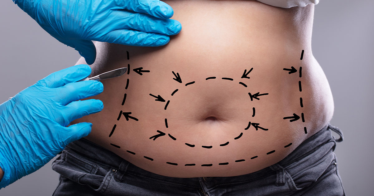 Liposuction (Yağ Alma)