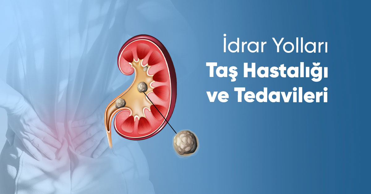 İdrar Yolları Taş Hastalığı ve Tedavileri