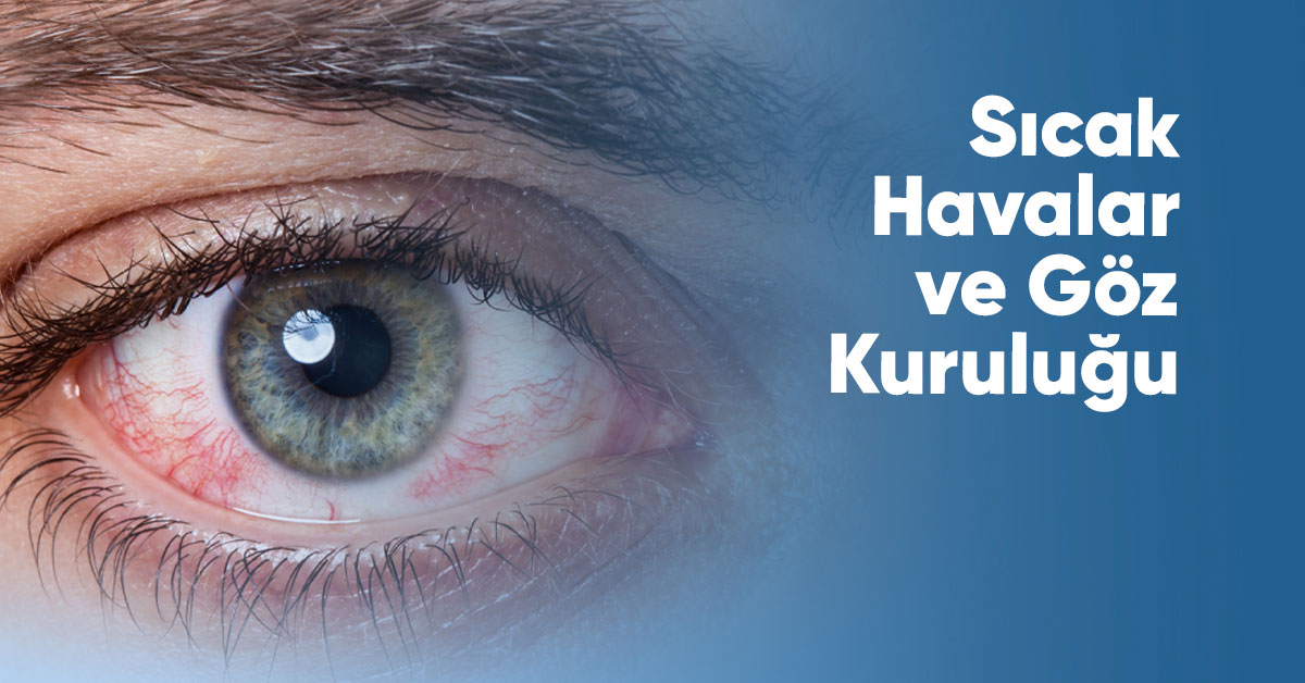Sıcak Havalar ve Göz Kuruluğu 